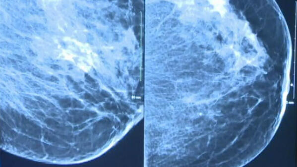 3D mammogram