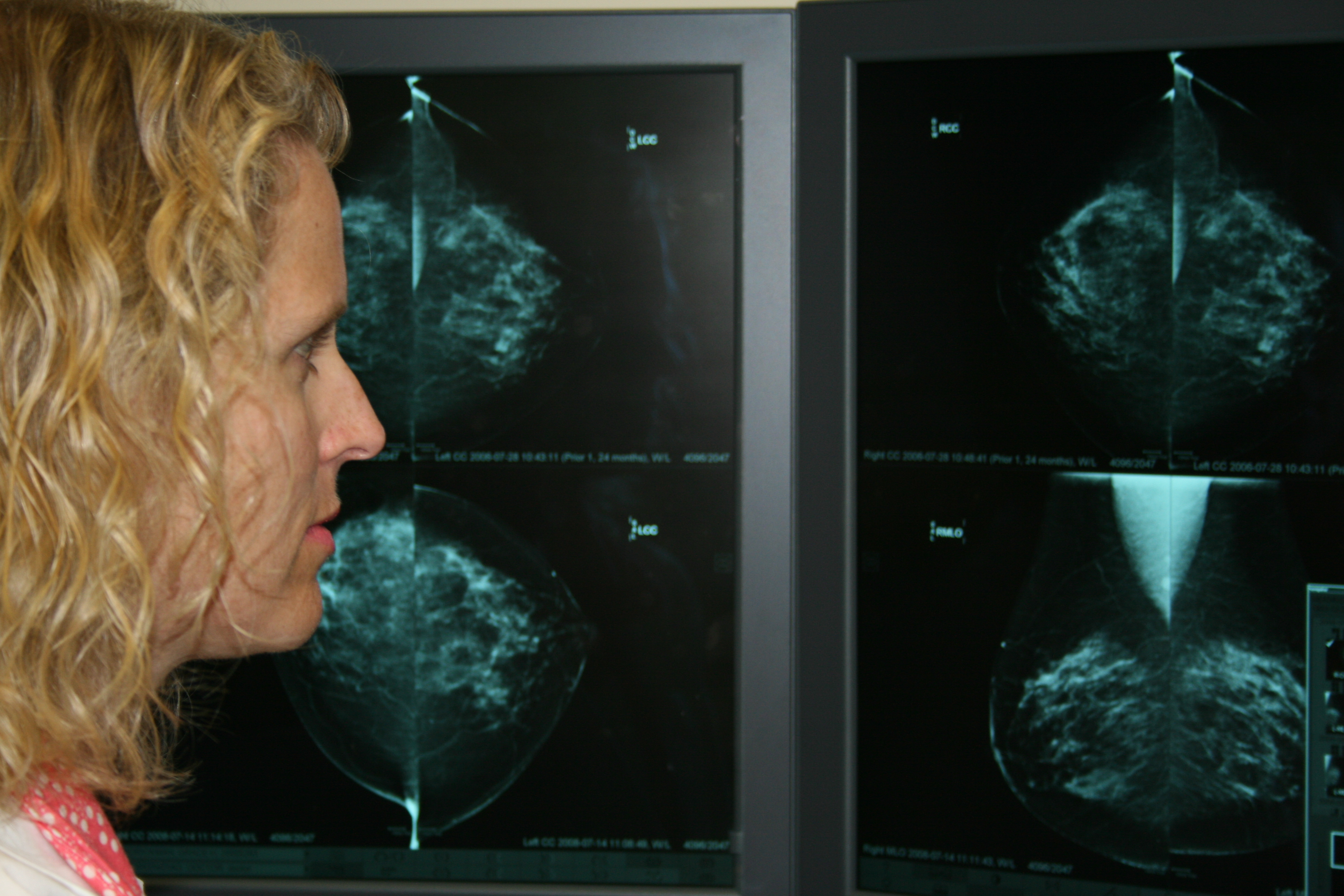 How Does a Radiologist See Breast Cancer on Mammography & Ultrasound?